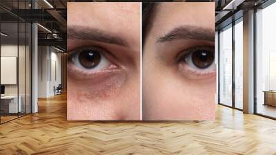 Collage with photos of woman with dark circle under eye before and after treatment, closeup Wall mural