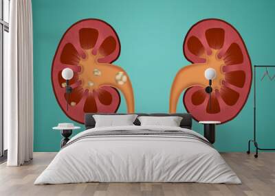 Illustration of human kidneys, one with stones on blue background Wall mural