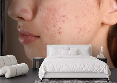 Teenage girl with acne problem on beige background, closeup Wall mural