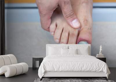 Human male foot with bruised black on toe nails Wall mural