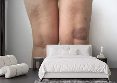 Close-up of a bruised kneecap with visible bruise and swelling. Bruises, hematomas on the human body. Healthcare and medicine, recovery from injuries Wall mural