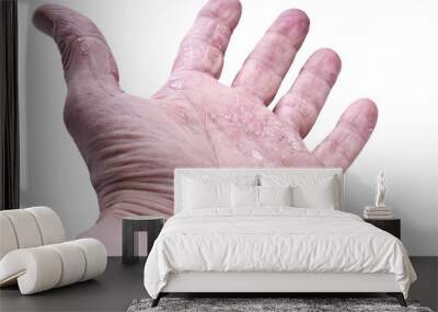 Psoriasis, skin disease on the joints of the body Wall mural