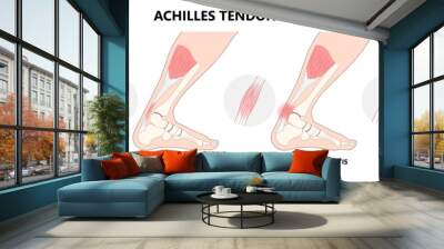 Small tear of Achilles tendon injury Feet calf test range of motion slight ache problem limb Thompson Simmonds and torn Rupture Wall mural