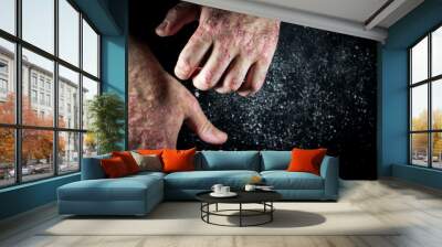 Psoriasis (eczema) on the hand Man itching skin Psoriasis scales are scattered on black background Wall mural