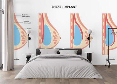 Breast Implant Concept Wall mural