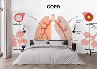 Chronic obstructive pulmonary disease Wall mural