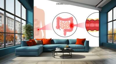 Chrons disease concept Wall mural