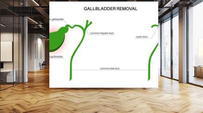 gallbladder removal surgery Wall mural