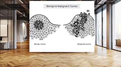 Vector  illustration of malignant and benign tumor Wall mural