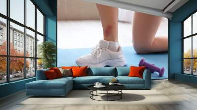 Sporty young woman with bruised leg in gym, closeup Wall mural