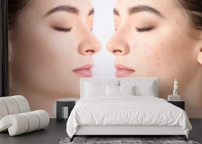 Young woman before and after acne treatment on light background Wall mural