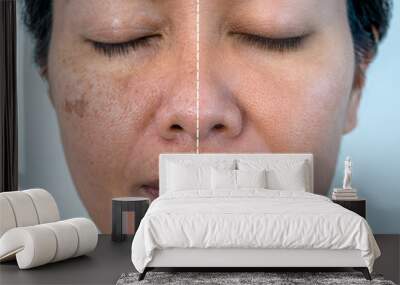 Retouched image to show before and after treatment spot melasma pigmentation facial treatment on young asian woman face. Skincare and health problem concept.	 Wall mural