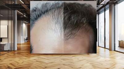 Comparison of hair loss treatment in men before and after – a visual journey to success Wall mural