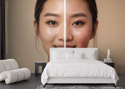 Portrait of a beautiful Asian woman with acne before and after treatment, showing healthy skin transformation. Closeup photo of Korean female  acne-prone skin problem with pimples and red acne scars Wall mural