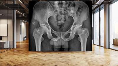 Pelvic X-ray AP with Left and Right Femur Visualization Wall mural