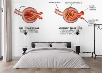 Diabetic Nephropathy, kidney disease Wall mural