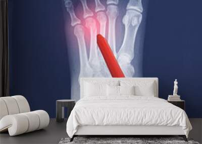 Close up X-ray Foot  AP-Lateral showing fracture 3th,4th metatarsal bone, Doctor holding a red pen point , symptoms medical healthcare concept. Wall mural