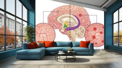 Medical illustration compares healthy blood vessels of the brain, with others affected by transient ischemic attacks which are one of the causes of vascular dementia in the brain. Wall mural