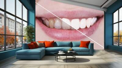 blanqueamiento dental Wall mural