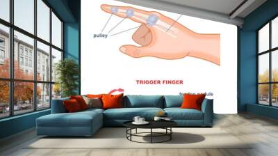 Trigger finger diagram. Joints stuck in bent position. Anatomy of tendons and bones of hand index finger. Medical trauma flexor tendon from inside educational scheme. Cartoon flat vector illustration Wall mural