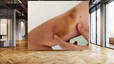 Portrait the bruise on the arm, pain on the body of the woman, health care and medical concept. Wall mural