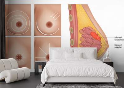 Traditional breast massage for treatment of clogged milk duct. Lactation Massage. Clogged milk duct. Inflamed breast lobe. Clogged milk duct. Inflamed breast lobe. Mastitis Wall mural