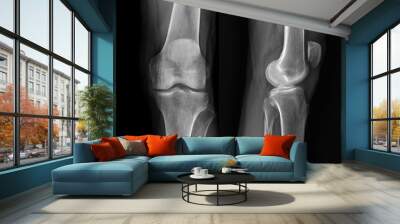 film x-ray  both knee joint  AP view  for diagnosis knee pain from osteoarthritis knee  and fracture . Wall mural