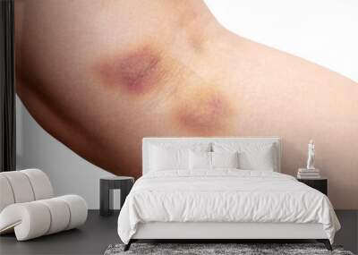 closeup bruise on human skin on a white background. Wall mural