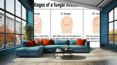 three stages of development of fungal infection on nail of the toe Wall mural