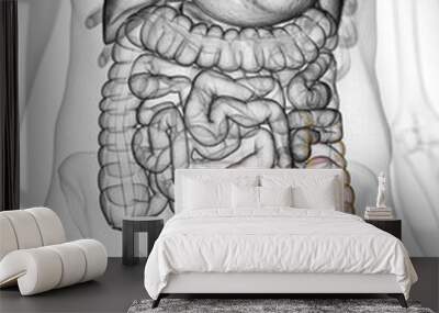 3d rendered, medically accurate illustration of bowel cancer Wall mural