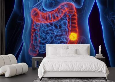 3D rendered Medical Illustration of Male Anatomy - Colon Cancer; Descending Colon. Wall mural