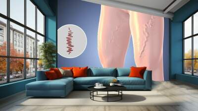 Leg thighs with varicose veins medical concept Wall mural