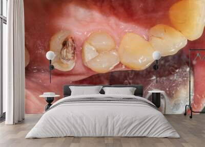 Maxillary arch with decayed premolar crown half destroyed, remaining root canal cavity in endodontics treatment. Directly below view and lip retracted with metallic dental mirror instrument Wall mural