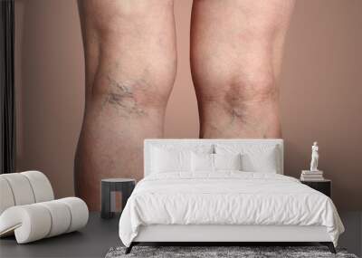 The varicose veins on a legs of woman Wall mural