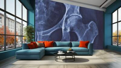 X-ray image of hip joint with signs of coxarthrosis Wall mural