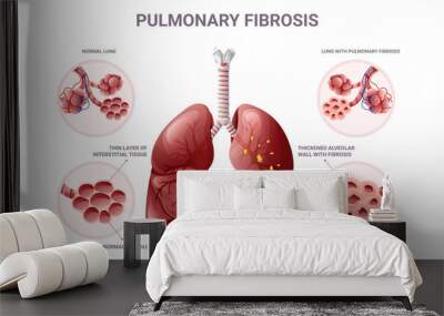 Pulmonary fibrosis and normal lung tissue infographic. Vector illustration isolated on white background Wall mural