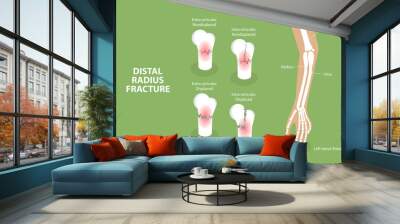 3D Isometric Flat Vector Conceptual Illustration of Distal Radius Fracture, Labeled Educational Diagram Wall mural