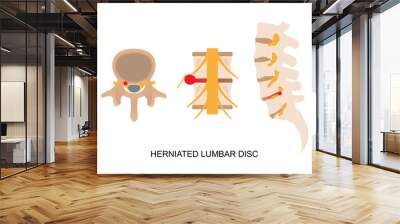 Illustration of herniated lumbar disc in different view. Wall mural