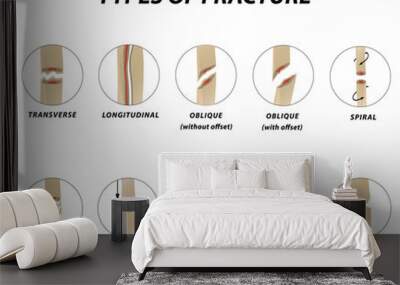 Types of fracture. Fracture bone set. Infographics. Vector illustration on a lined background. Wall mural