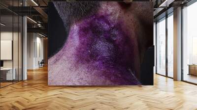 Close-up of a neck with a vivid purple bruise, showcasing skin texture and color variation in a dramatic light. Wall mural