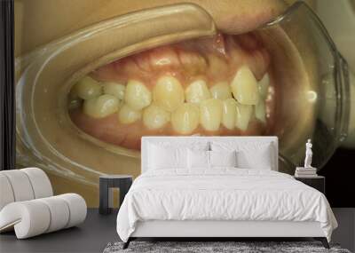 malocclusion teeth from side view Wall mural