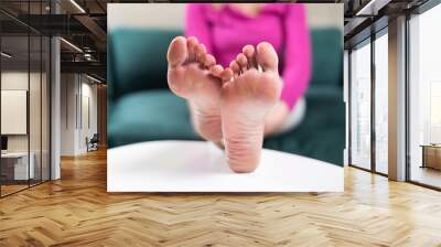 Close up of woman legs with callus on it. Feet with corn caused of heels. Need of pedicure  Wall mural