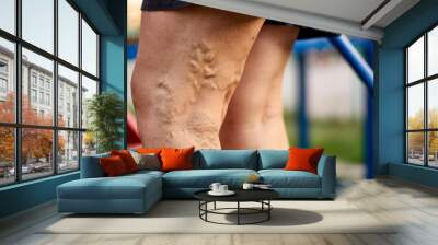 Painful varicose and spider veins on womans legs, who is active, self-helping herself. Healthcare Wall mural