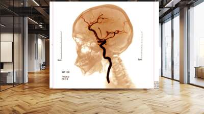 blood vessels x-ray images in the brain for diagnose cerebrovascular disease or hemorrhagic stroke. Wall mural