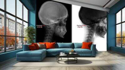 X-ray of the cervical spine. Kimerly anomaly. Cervical dysfunction. Marker. Wall mural