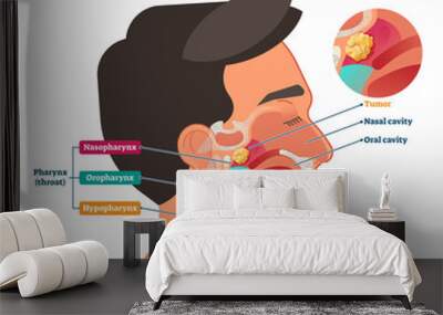 Nasopharyngeal carcinoma tumor, vector illustration Wall mural