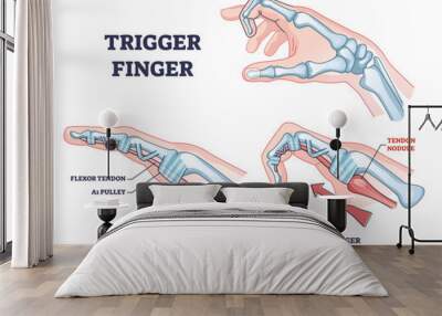 Trigger finger as finger stuck in bent position condition outline diagram. Labeled educational scheme with medical trauma with bending index finger, flexor tendon or pulley anatomy vector illustration Wall mural