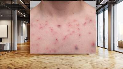 acne on a males chest. result of using steroids and anabolics Wall mural