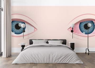 Healthy and ill human vision organ. Dry eye syndrom. Inflamed eyeball with irritation and red conjunctiva. Symptoms of keratitis, blepharitis, conjunctivitis or uveitis. Vector flat illustration. Wall mural