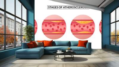 stages of atherosclerosis. Atherosclerosis formation Healthy artery and unhealthy arteries. Wall mural